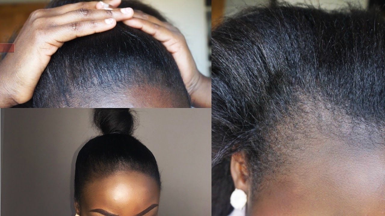 How To Thicken And Cover Up Bald Edges (View 3 of 15)