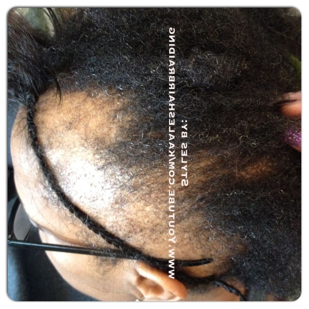 Preferred Braided Hairstyles Cover Bald Edges Regarding Tree Braids, Non Surgical Hair Loss Solutions (View 13 of 15)