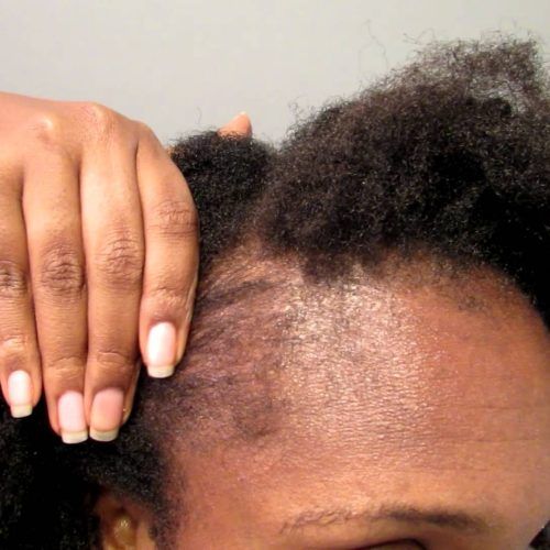 Braided Hairstyles Cover Bald Edges (Photo 11 of 15)